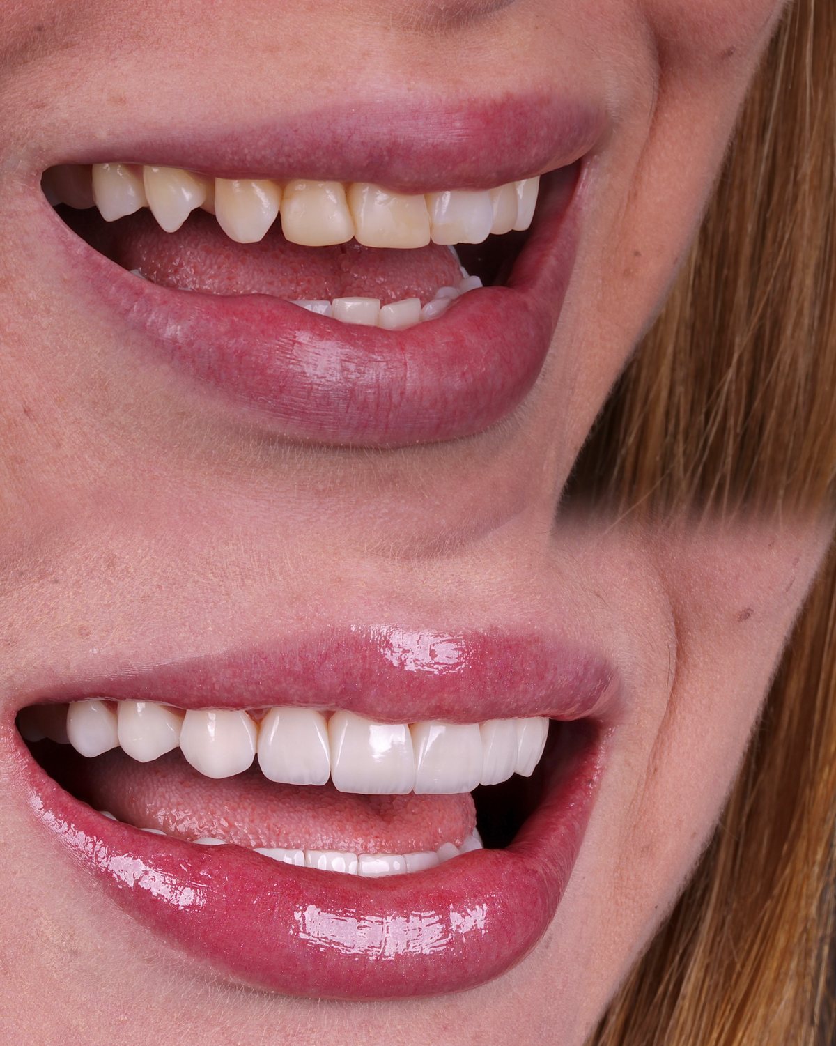 Comparação do sorriso antes e depois do tratamento