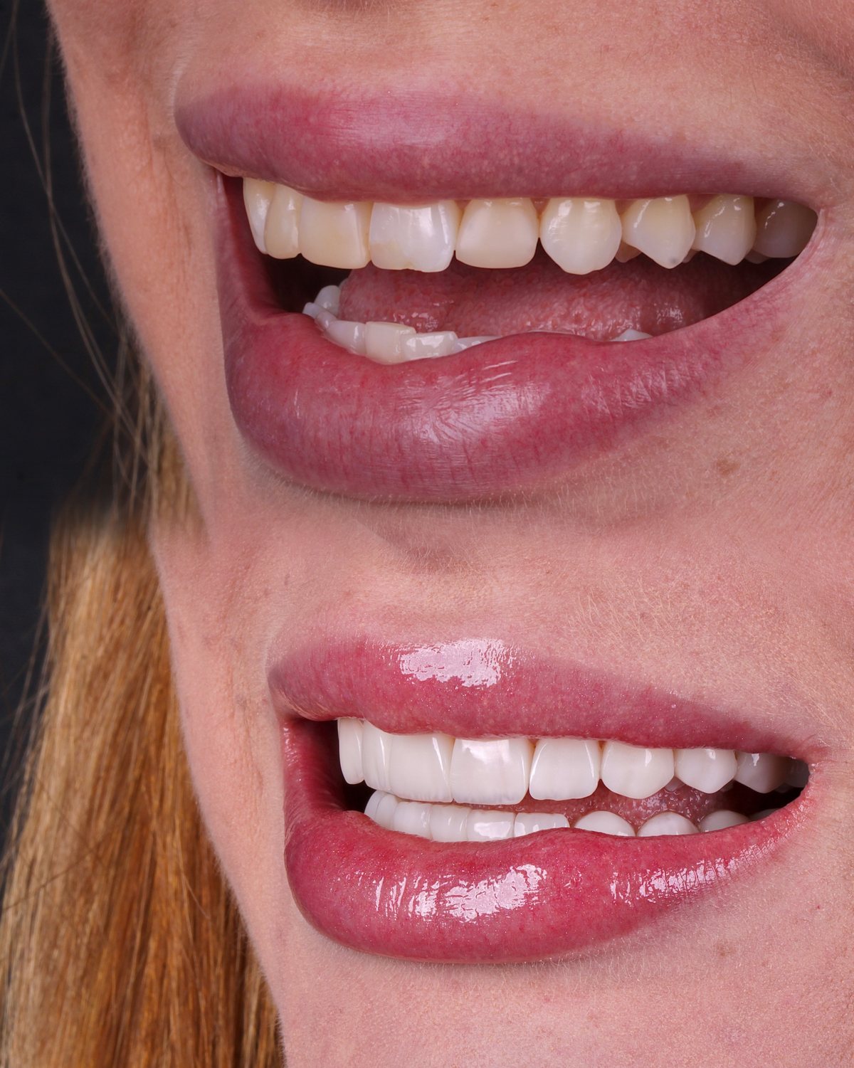 Comparação do sorriso antes e depois, vista aproximada