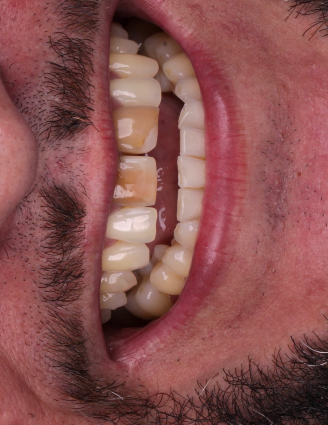 Sorriso antes do tratamento, vista lateral