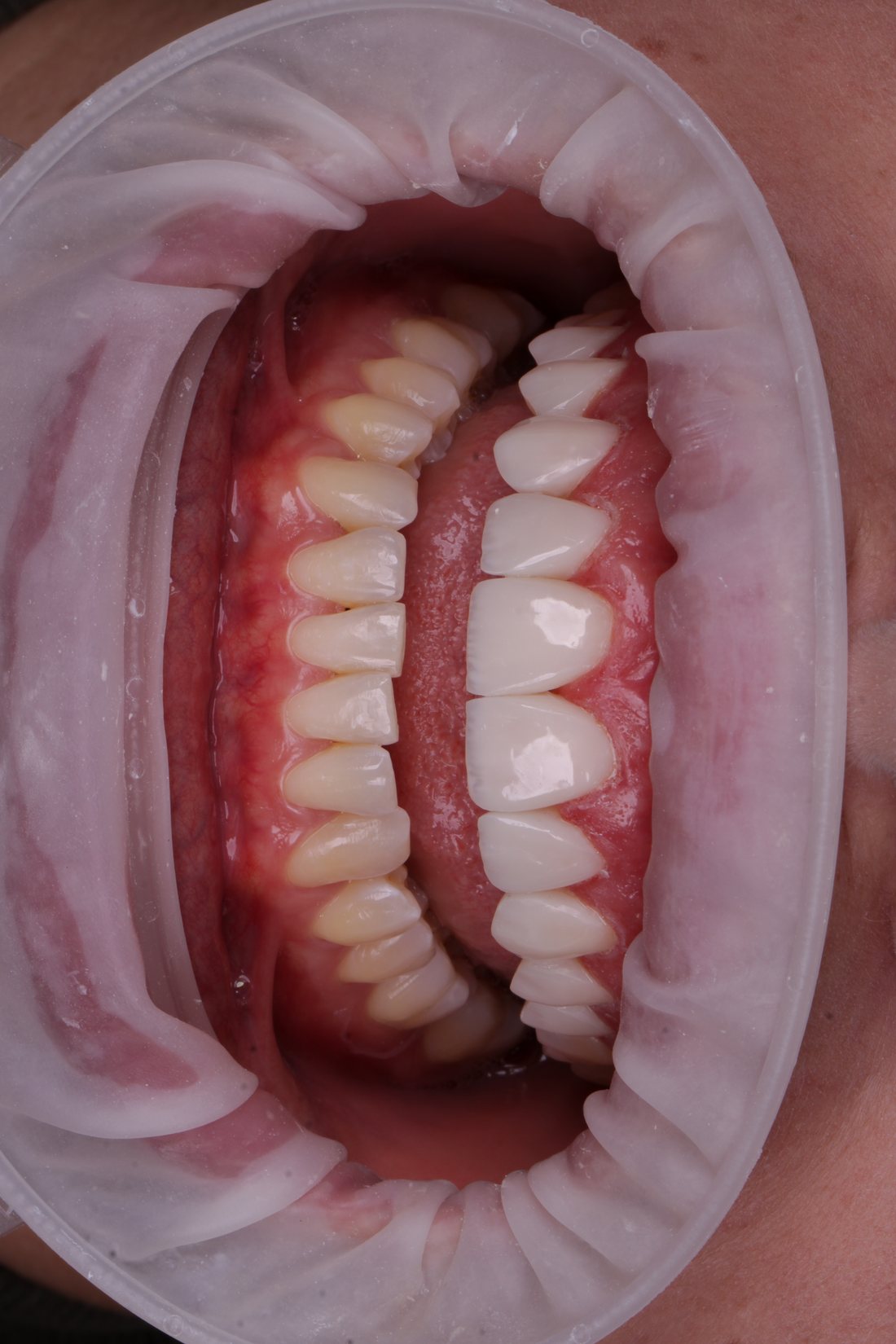 Registro intraoral comparando as arcadas
