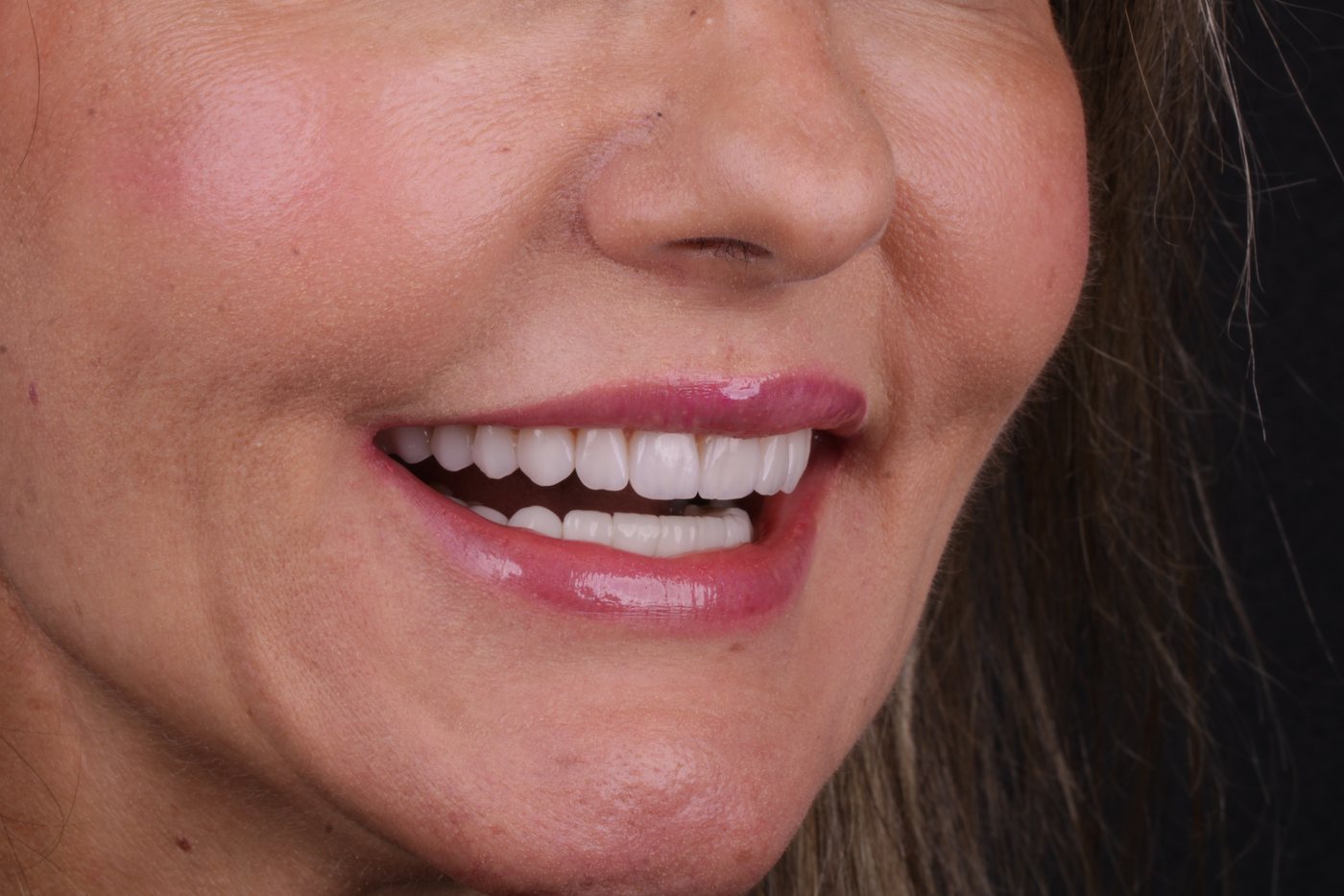 Sorriso reabilitado, vista lateral