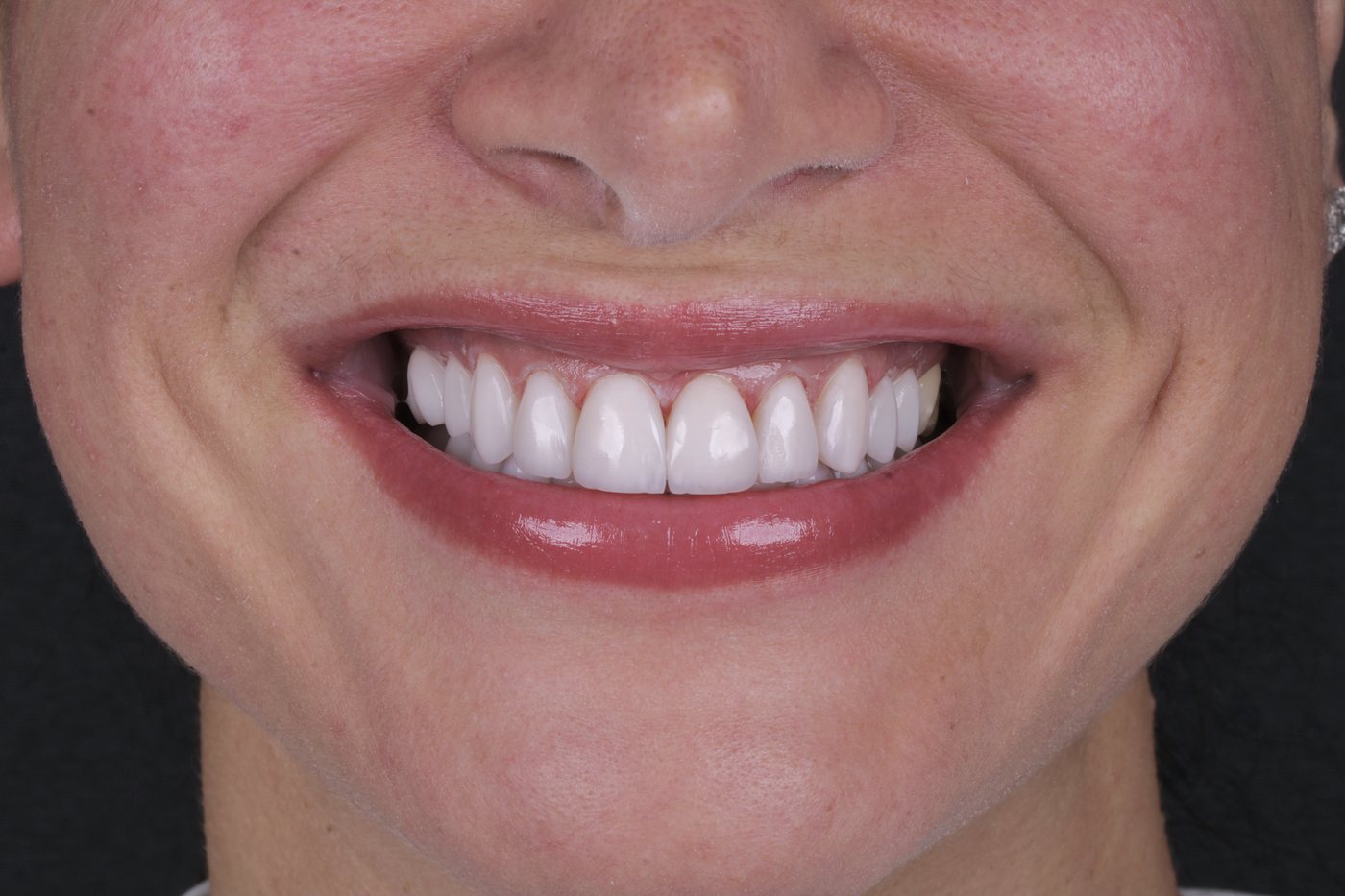 Sorriso frontal após reabilitação estética